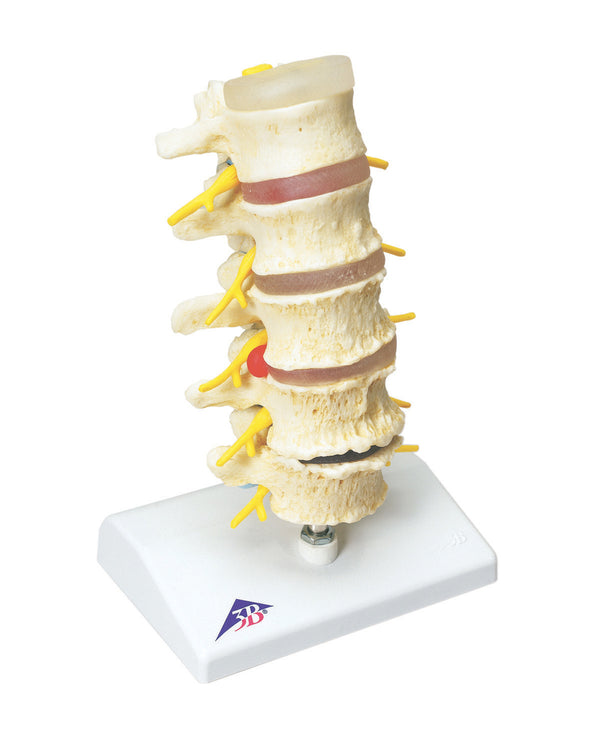 Anatomical Model - vertebrae degeneration, stages of prolapsed disc