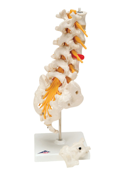 Anatomical Model - lumbar spinal column with dorso-lateral prolapsed disc