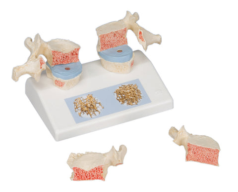 Anatomical Model - osteoporosis model