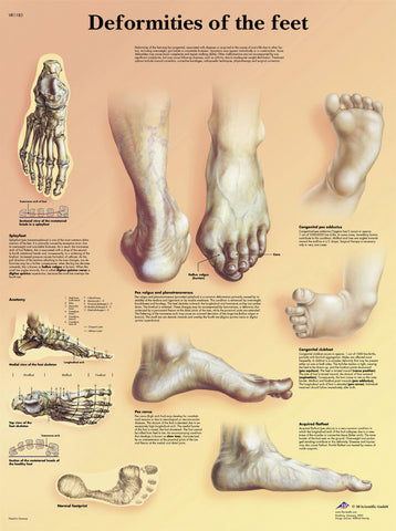 Anatomical Chart - deformities of the feet, paper