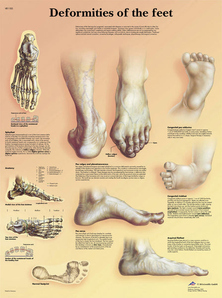 Anatomical Chart - deformities of the feet laminated