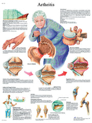 Anatomical Chart - arthritis, paper