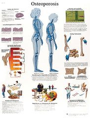 Anatomical Chart - osteoporosis, laminated